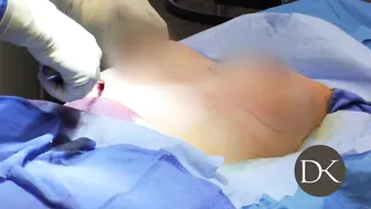 Breast Augmentation Transumbilical Technique and Rhinoplasty #5