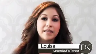 Liposuction and Fat Transfer Testimonial #2