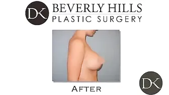 Breast Augmentation testimonial №2 #10