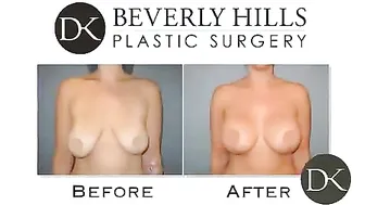 Breast Augmentation with a Mastopexy Before and After #10