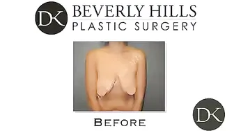 Breast Augmentation with a Mastopexy Before and After #2