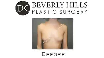 My Breast Implants are a total success - Breast Augmentation #10