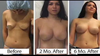 Breast augmentation - before and after video breast augmentation #1