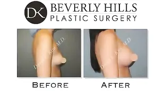 Breast augmentation - before and after video breast augmentation #10