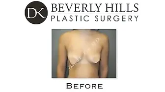 Breast augmentation - before and after video breast augmentation #9