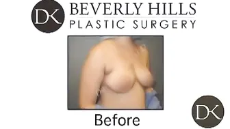 Breast Augmentation with Circumareolar Lift #10