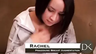 Breast Augmentation with Circumareolar Lift #2