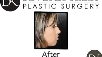 Breast Augmentation, Liposuction, and Rhinoplasty #10