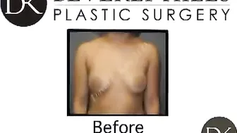 Breast Augmentation, Liposuction, and Rhinoplasty #9