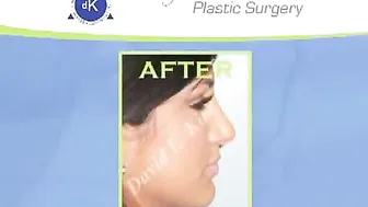 Beverly Hills Finesse Rhinoplasty - Plastic Surgery Nose - Rhinoplasty Video #10