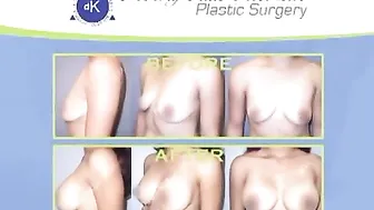 Mommy Makeover Surgery - Beverly Hills Breast & Tummy Tuck Video #10