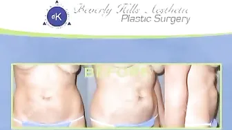 Mommy Makeover Surgery - Beverly Hills Breast & Tummy Tuck Video #9