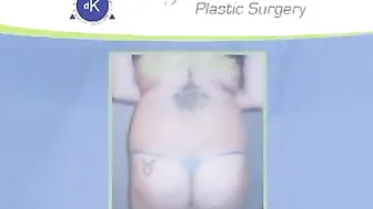 Fat Transfer to Buttocks - Liposuction Surgery with Injections in Butt #10