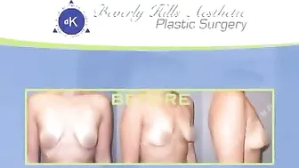 Breast Implants with Lift Los Angeles Plastic Surgeon #9