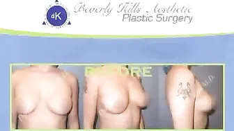 Silicone Breast Augmentation B cup to a D cup & Rhinoplasty Nose Job #10