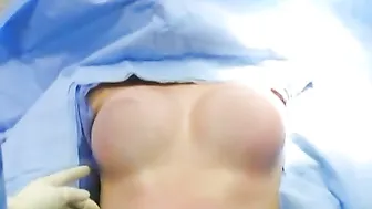 Umbilical Breast Augmentation to go Larger - Dr. Kim Los Angeles / Beverly Hills #8