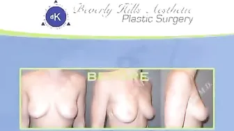 Breast Augmentation : Rhinoplasty : Los Angeles #7