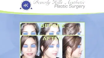 My Nose Surgery Results (Rhinoplasty) - Dr. Kim, Beverly Hills, California Nose Job #2