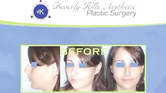 My Nose Surgery Results (Rhinoplasty) - Dr. Kim, Beverly Hills, California Nose Job #7