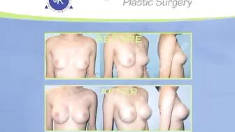 Breast Augmentation - Breast Implants - Breast Enlargement #2