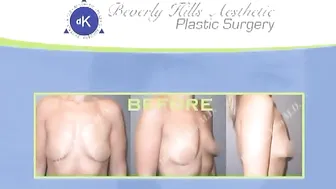 Breast Augmentation - Breast Implants - Breast Enlargement #9