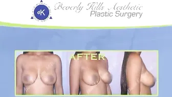 Breast Lift with Silicone Implant Augmentation Before and After #2