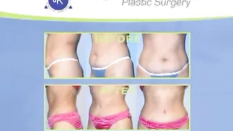 Tummy Tuck (Abdominoplasty) - Beverly Hills #2