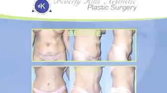 Tummy Tuck (Abdominoplasty) - Beverly Hills #7